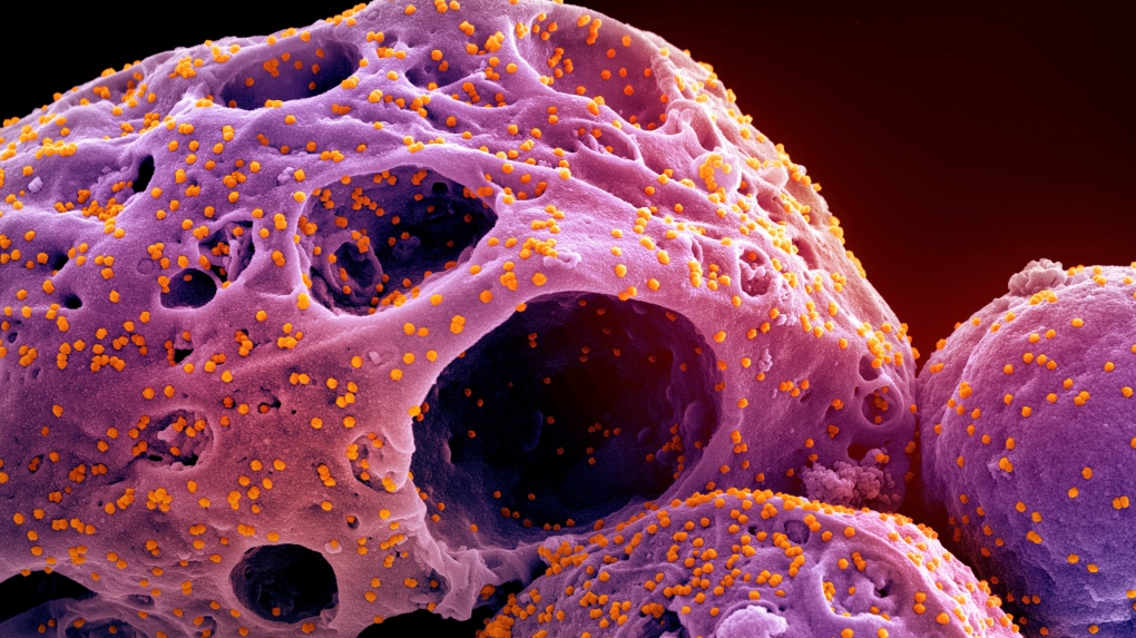 This colorized electron microscope image made available by the National Institute of Allergy and Infectious Diseases in November 2022, shows cells, indicated in purple, infected with the omicron strain of the SARS-CoV-2 virus, orange, isolated from a patient sample, captured at the NIAID Integrated Research Facility (IRF) in Fort Detrick, Md. (NIAID/NIH via AP)